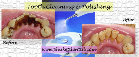 Tooth Cleaning&Air Flow/Polishing at Phuket Dental Clinic,Thailand
